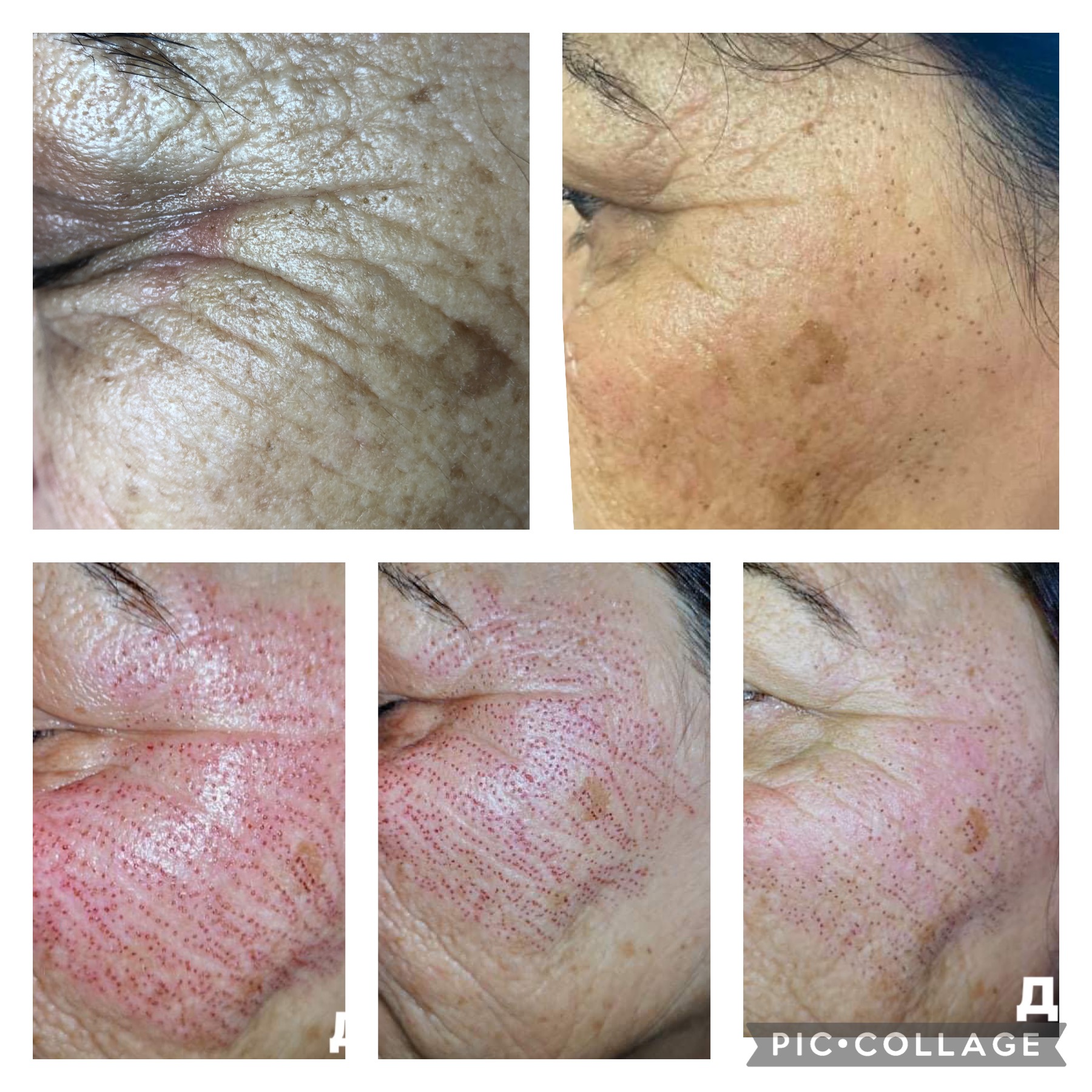 ✨ FibroBlast  – плазмен лифтинг 